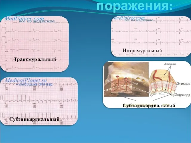 По анатомии поражения: Интрамуральный Трансмуральный Субэпикардиальный Субэндокардиальный