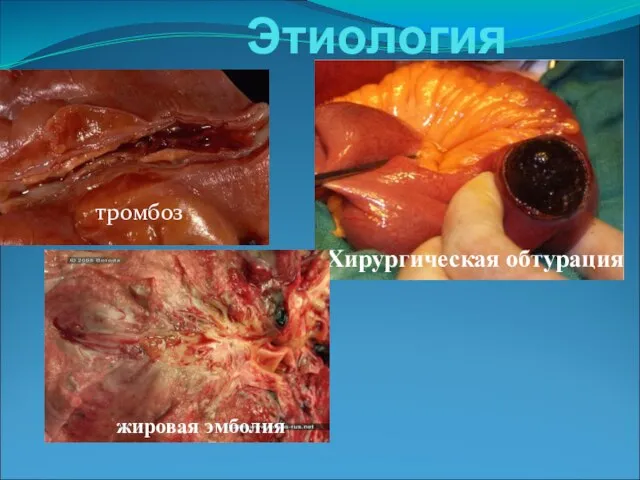 Этиология тромбоз Хирургическая обтурация жировая эмболия