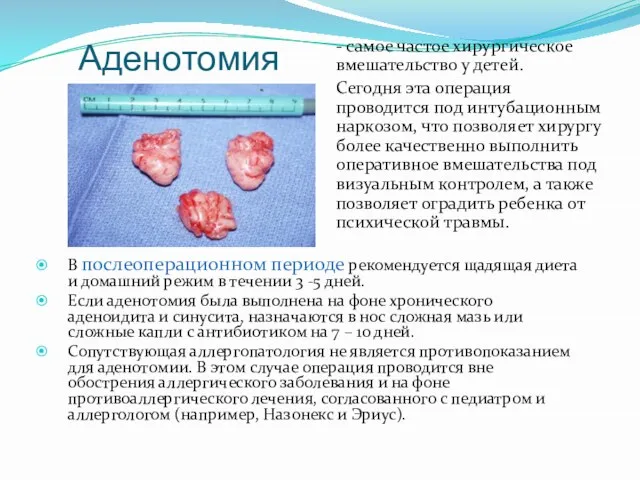 Аденотомия - самое частое хирургическое вмешательство у детей. Сегодня эта операция