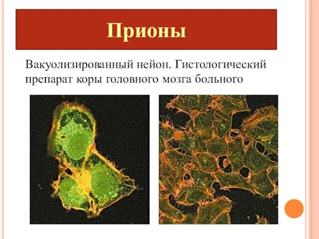 Прионы Вакуолизированный нейон. Гистологический препарат коры головного мозга больного