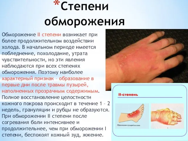 Степени обморожения Обморожение II степени возникает при более продолжительном воздействии холода.