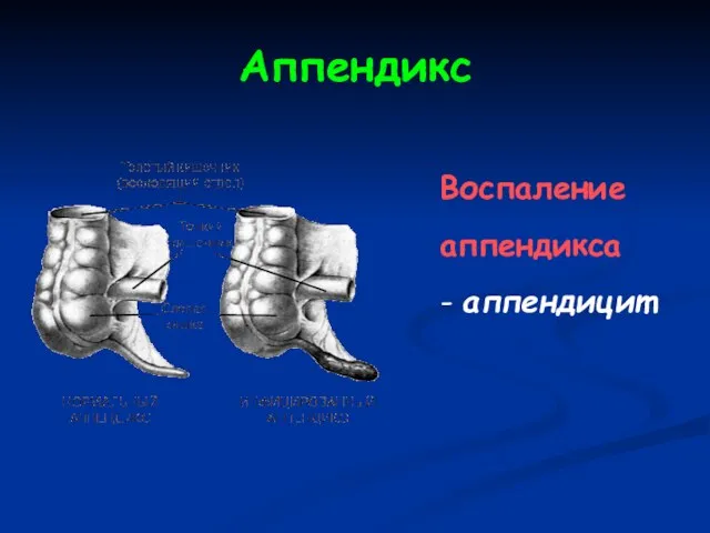 Аппендикс Воспаление аппендикса - аппендицит