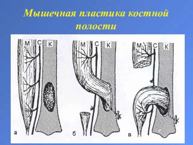 Мышечная пластика костной полости