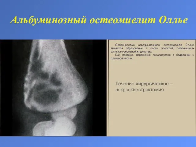 Альбуминозный остеомиелит Оллье Лечение хирургическое – некрсеквестрэктомия