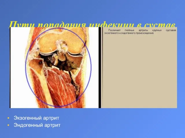 Пути попадания инфекции в сустав Экзогенный артрит Эндогенный артрит