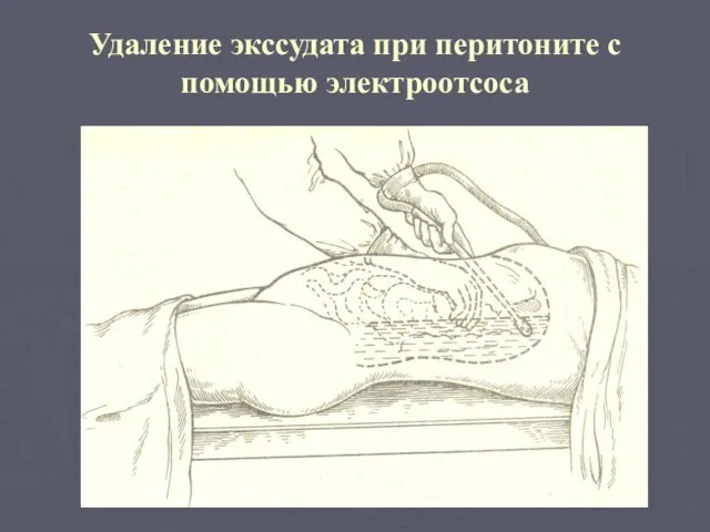 Удаление экссудата при перитоните с помощью электроотсоса