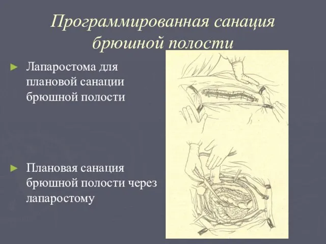 Программированная санация брюшной полости Лапаростома для плановой санации брюшной полости Плановая санация брюшной полости через лапаростому