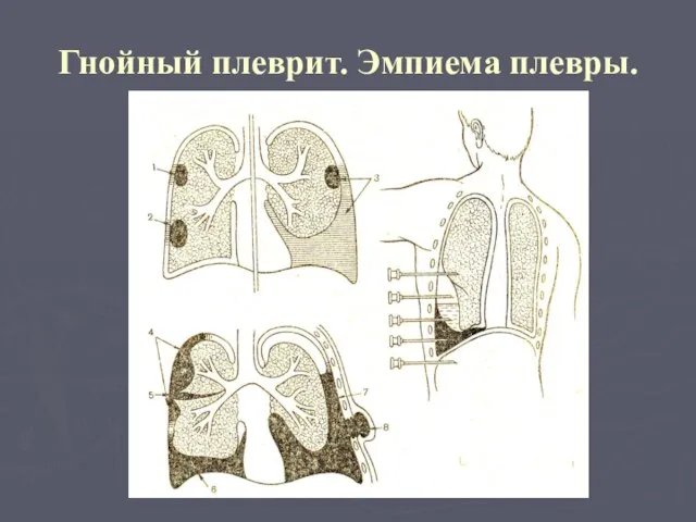 Гнойный плеврит. Эмпиема плевры.