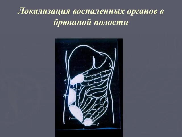 Локализация воспаленных органов в брюшной полости