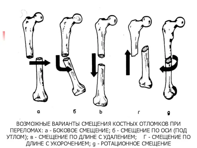 ВОЗМОЖНЫЕ ВАРИАНТЫ СМЕЩЕНИЯ КОСТНЫХ ОТЛОМКОВ ПРИ ПЕРЕЛОМАХ: а - БОКОВОЕ СМЕЩЕНИЕ;