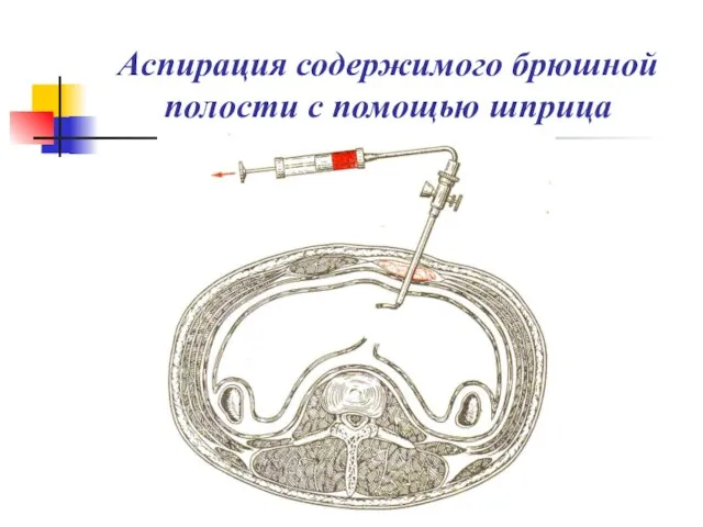 Аспирация содержимого брюшной полости с помощью шприца