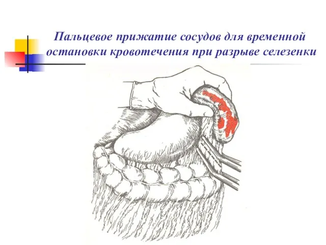 Пальцевое прижатие сосудов для временной остановки кровотечения при разрыве селезенки