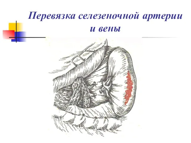 Перевязка селезеночной артерии и вены