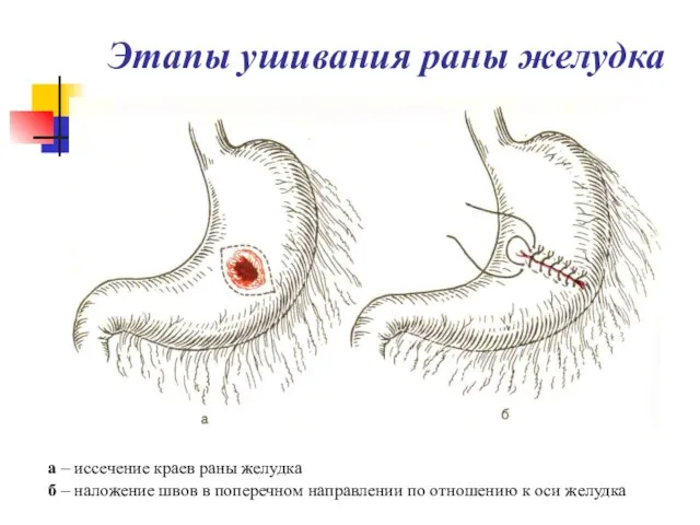 Этапы ушивания раны желудка а – иссечение краев раны желудка б