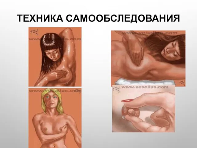 Техника самообследования