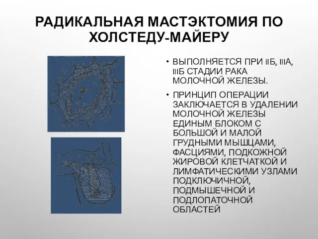 Радикальная мастэктомия по Холстеду-Майеру Выполняется при IIб, IIIа, IIIб стадии рака