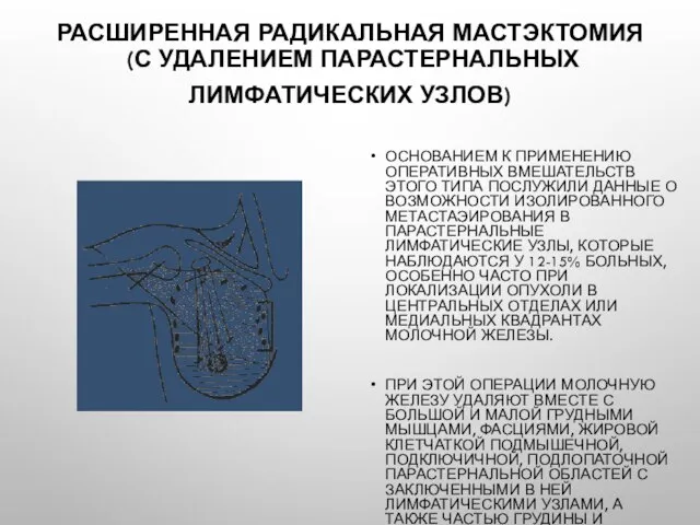 Расширенная радикальная мастэктомия (с удалением парастернальных лимфатических узлов) Основанием к применению