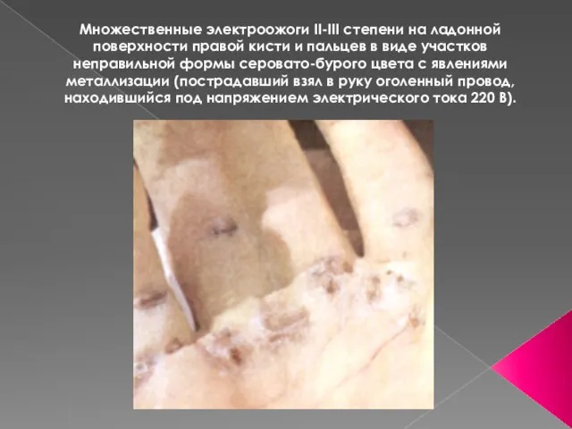 Множественные электроожоги II-III степени на ладонной поверхности правой кисти и пальцев