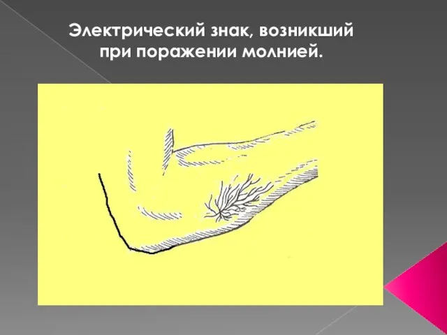 Электрический знак, возникший при поражении молнией.