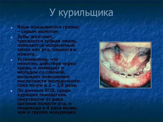 У курильщика Язык покрывается грязно – серым налётом. Зубы желтеют, трескается