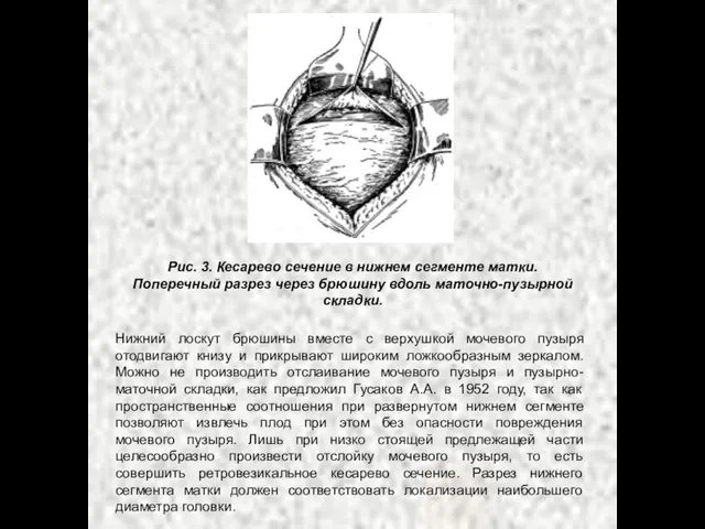 Рис. 3. Кесарево сечение в нижнем сегменте матки. Поперечный разрез через