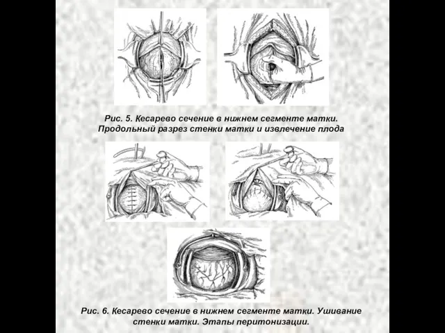 Рис. 5. Кесарево сечение в нижнем сегменте матки. Продольный разрез стенки