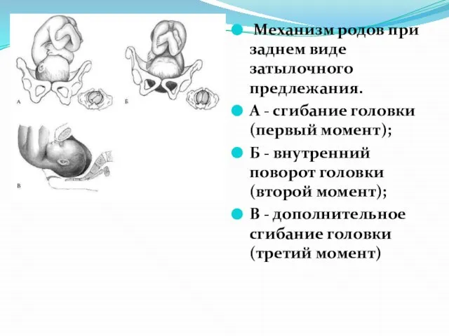 Механизм родов при заднем виде затылочного предлежания. А - сгибание головки