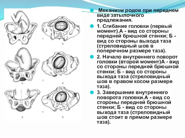 Механизм родов при переднем виде затылочного предлежания. 1. Сгибание головки (первый