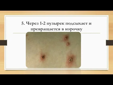 5. Через 1-2 пузырек подсыхает и превращается в корочку