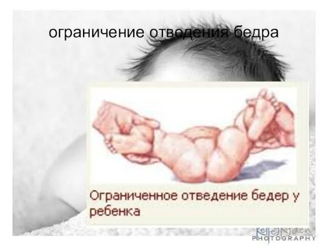 ограничение отведения бедра