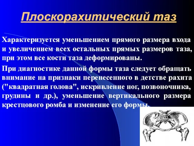 Плоскорахитический таз Характеризуется уменьшением прямого размера входа и увеличением всех остальных