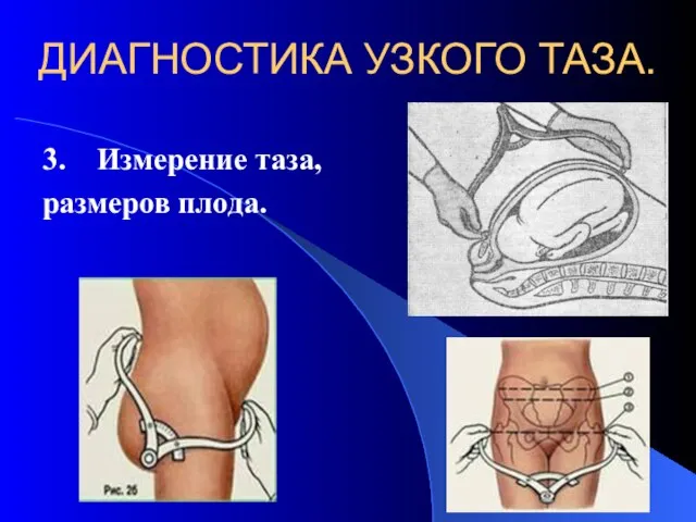 ДИАГНОСТИКА УЗКОГО ТАЗА. 3. Измерение таза, размеров плода.