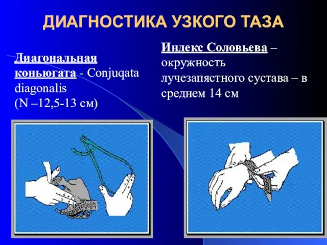 ДИАГНОСТИКА УЗКОГО ТАЗА Диагональная коньюгата - Cоnjuqata diagonalis (N –12,5-13 см)