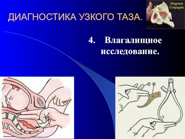 ДИАГНОСТИКА УЗКОГО ТАЗА. 4. Влагалищное исследование.