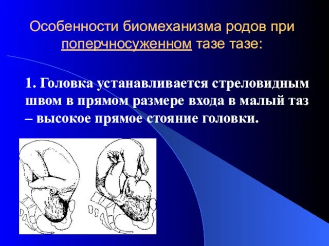 Особенности биомеханизма родов при поперчносуженном тазе тазе: 1. Головка устанавливается стреловидным