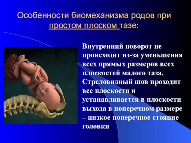 Особенности биомеханизма родов при простом плоском тазе: Внутренний поворот не происходит