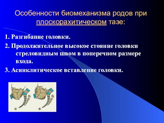 Особенности биомеханизма родов при плоскорахитическом тазе: 1. Разгибание головки. 2. Продолжительное