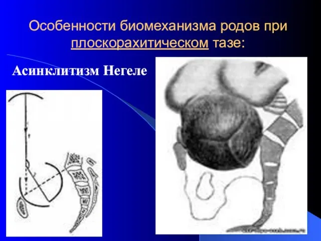 Особенности биомеханизма родов при плоскорахитическом тазе: Асинклитизм Негеле