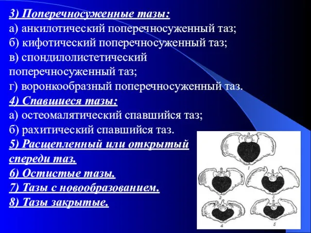 3) Поперечносуженные тазы: а) анкилотический поперечносуженный таз; б) кифотический поперечносуженный таз;