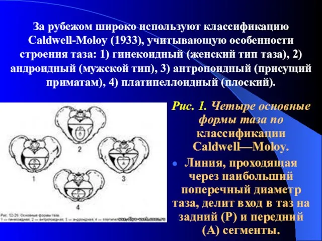 За рубежом широко используют классификацию Caldwell-Moloy (1933), учитывающую особенности строения таза:
