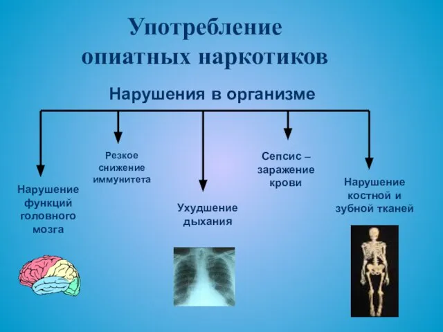 Употребление опиатных наркотиков Нарушение функций головного мозга Нарушение костной и зубной