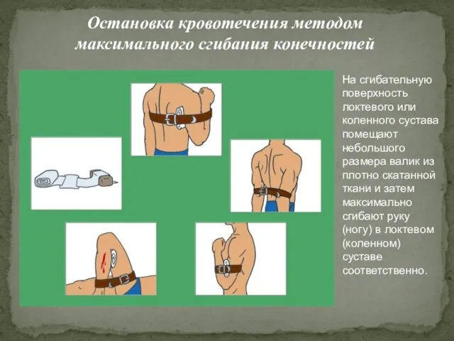 Остановка кровотечения методом максимального сгибания конечностей На сгибательную поверхность локтевого или