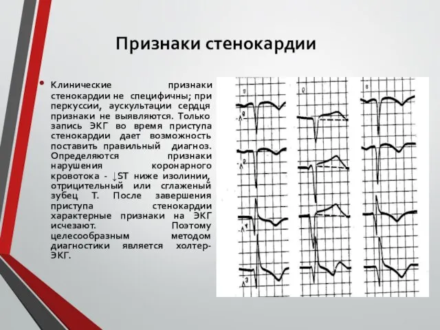 Признаки стенокардии Клинические признаки стенокардии не специфичны; при перкуссии, аускультации сердця