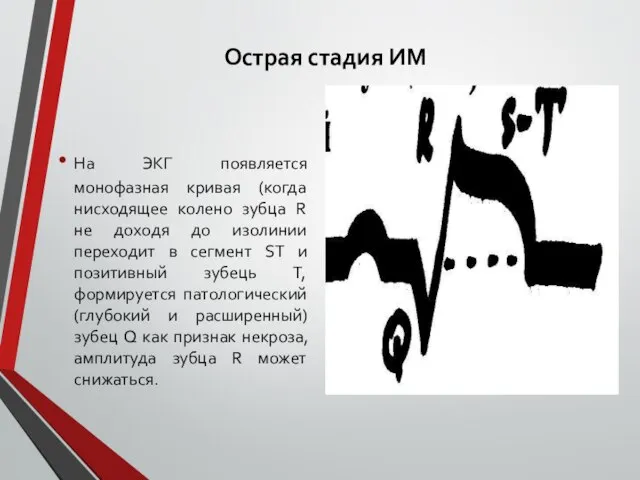 Острая стадия ИМ На ЭКГ появляется монофазная кривая (когда нисходящее колено