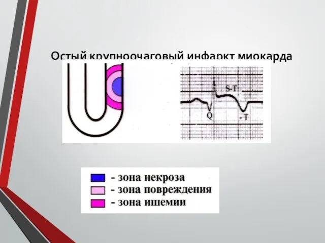 Остый крупноочаговый инфаркт миокарда