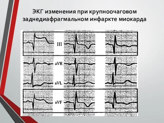 ЭКГ изменения при крупноочаговом заднедиафрагмальном инфаркте миокарда