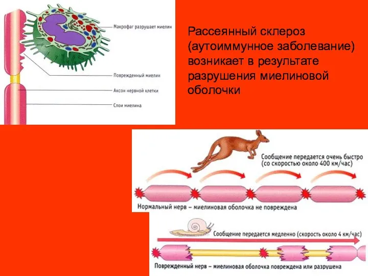 Рассеянный склероз (аутоиммунное заболевание) возникает в результате разрушения миелиновой оболочки