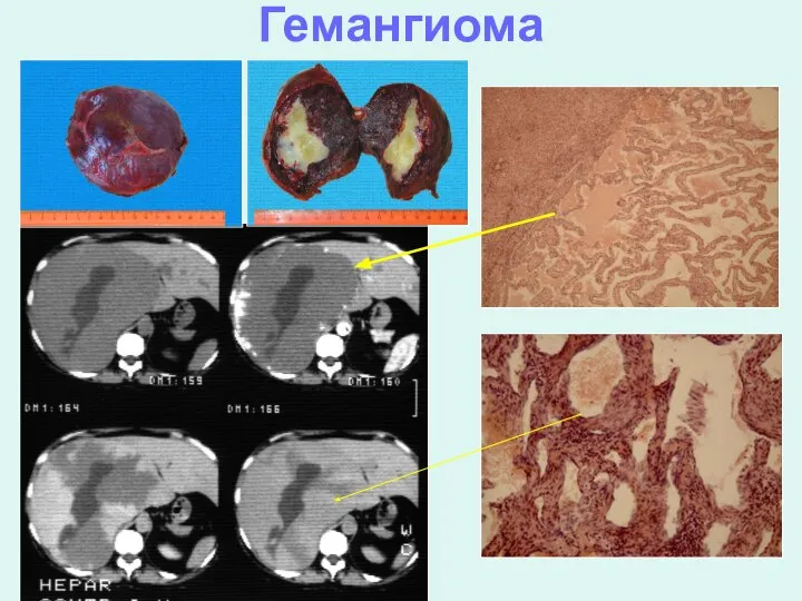 Гемангиома