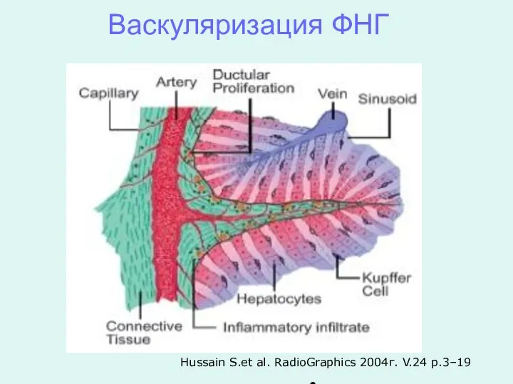 Васкуляризация ФНГ Hussain S.et al. RadioGraphics 2004г. V.24 p.3–19 ●