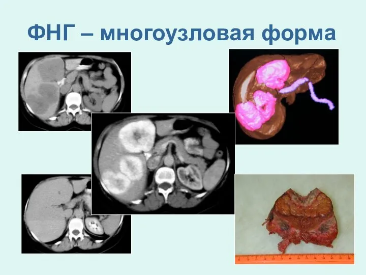 ФНГ – многоузловая форма